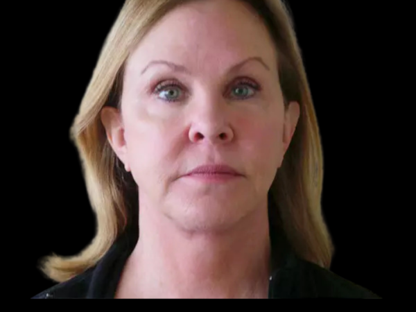 FaceLift Patient 01 After 1