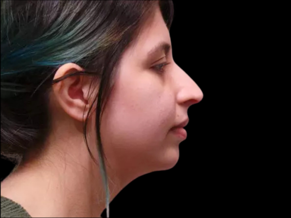 Chin Augmentation Patient 06 After 1
