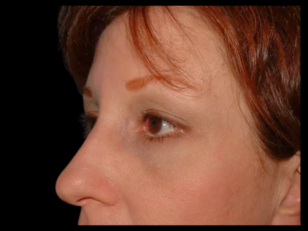 Brow Lift Patient 01 After 2