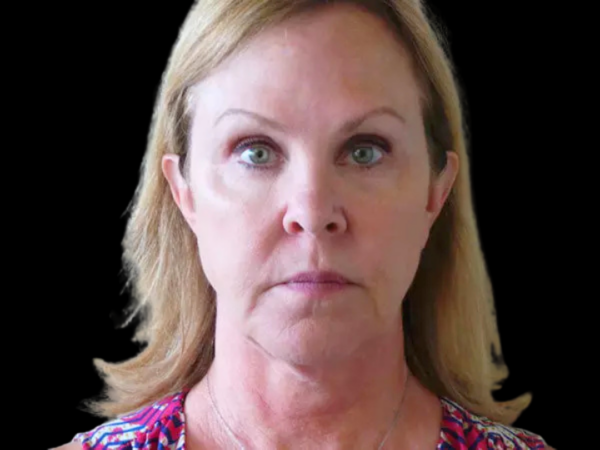 FaceLift Patient 01 Before 1