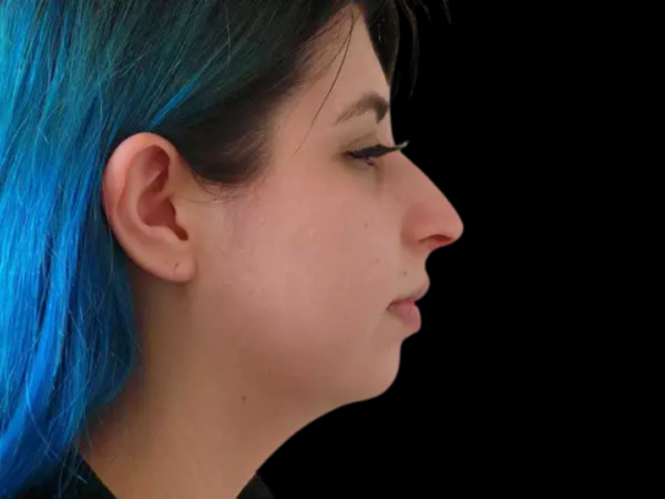 Chin Augmentation Patient 06 Before 1