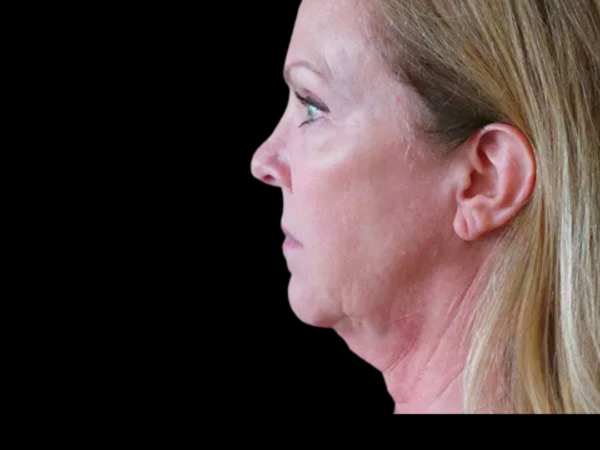 FaceLift Patient 01 Before 2