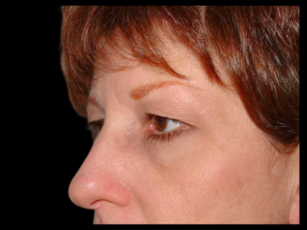 Brow Lift Patient 01 Before 2