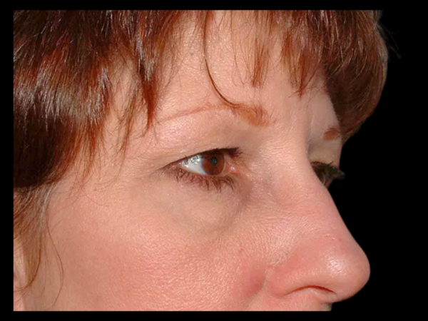 Brow Lift Patient 01 Before 1