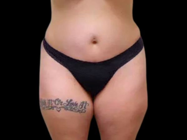 Liposuction Patient 04 After 1