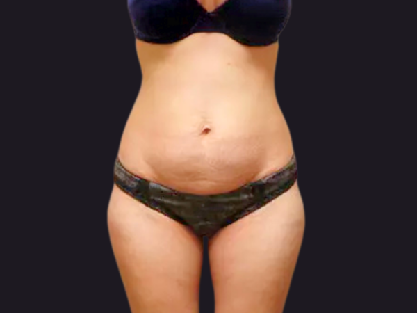 Tummy Tuck Patient 01 Before 1