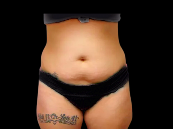 Lipo Case #310 Before 1