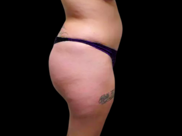 Liposuction Patient 04 After 2