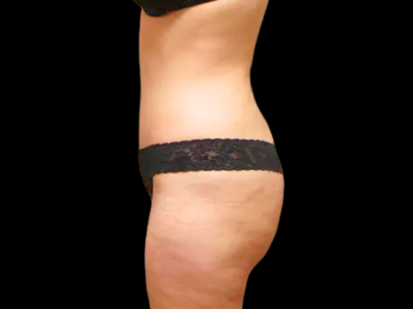 Tummy Tuck Patient 01 After 2