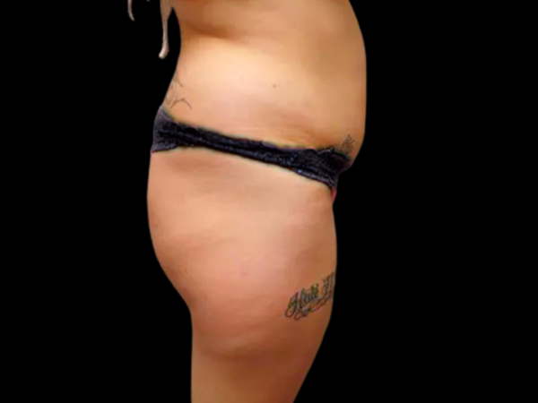 Liposuction Patient 04 Before 2