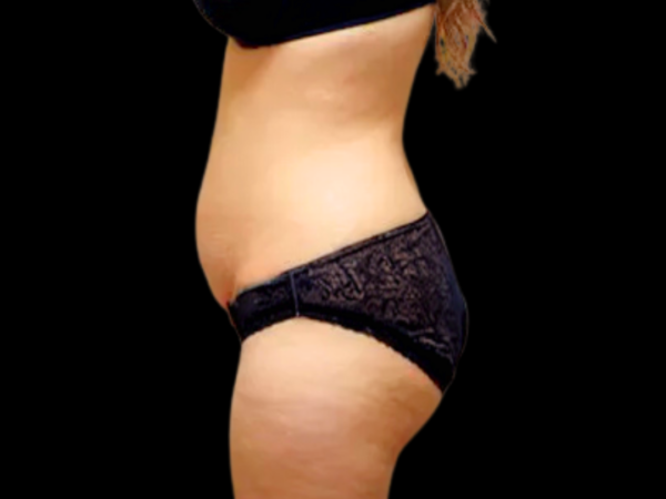 Tummy Tuck Patient 01 Before 2