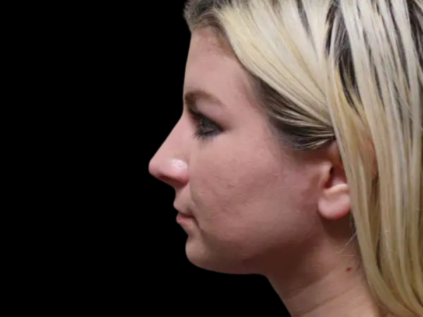 Rhinoplasty Patient 12 After 1
