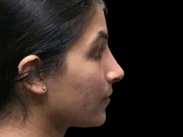 Rhinoplasty Patient 17 After 1