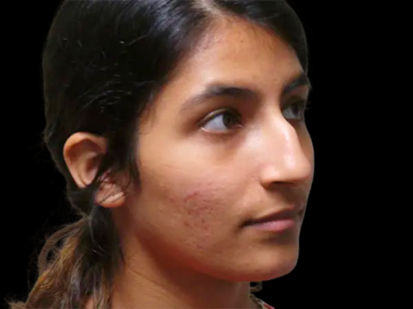 Rhinoplasty Patient 17 Before 2