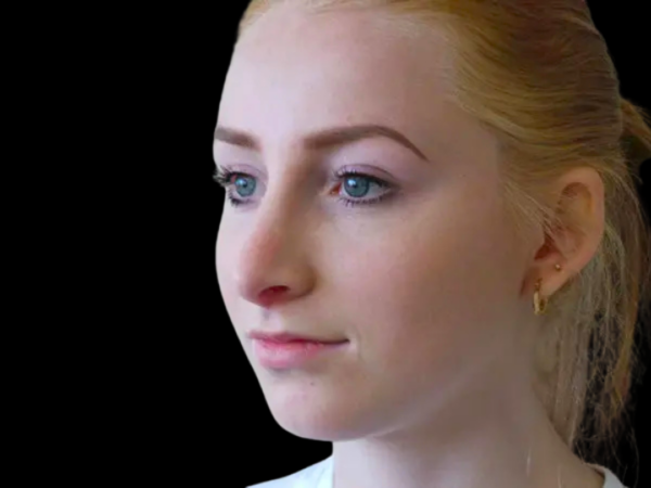 Rhinoplasty Patient 16 After 2