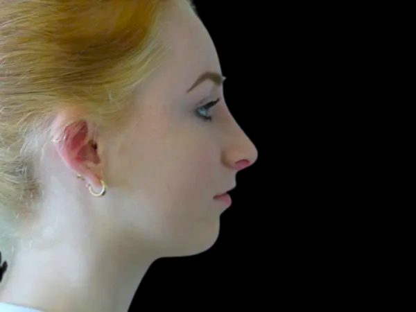 Rhinoplasty Patient 16 After 1