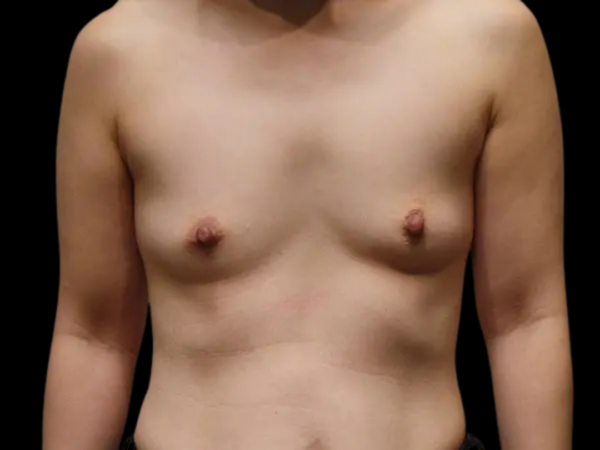 Breast Augmentation Patient 13 Before 1