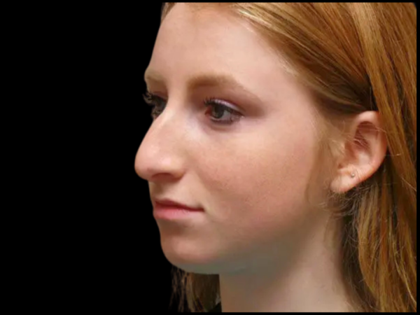 Rhinoplasty Patient 16 Before 2
