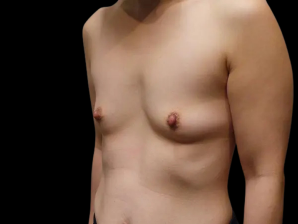 Breast Augmentation Patient 13 Before 2