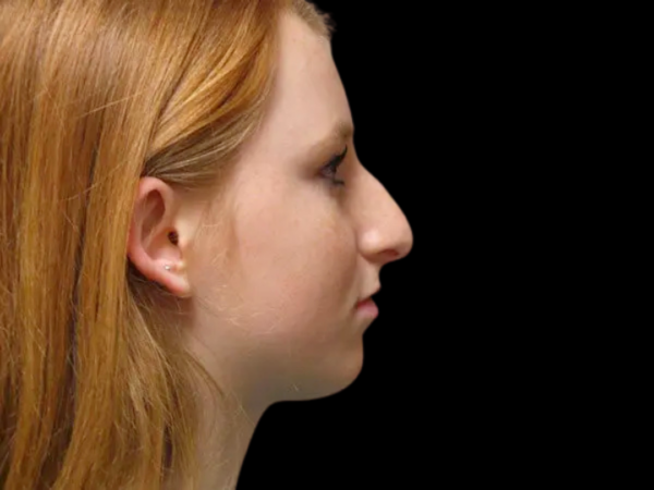 Rhinoplasty Patient 16 Before 1