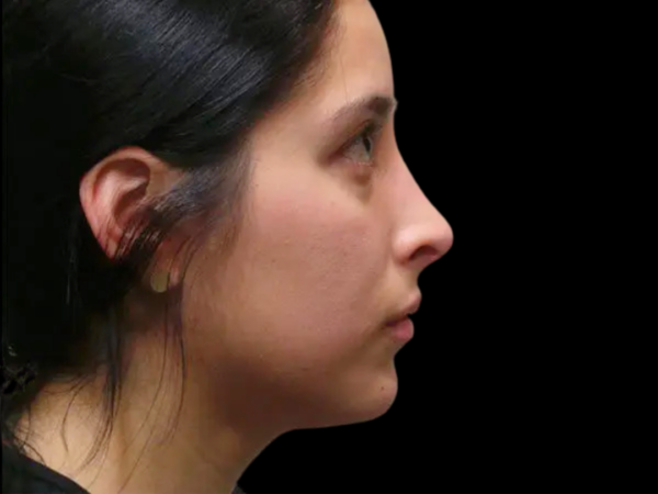 Rhinoplasty Patient 20 After 1