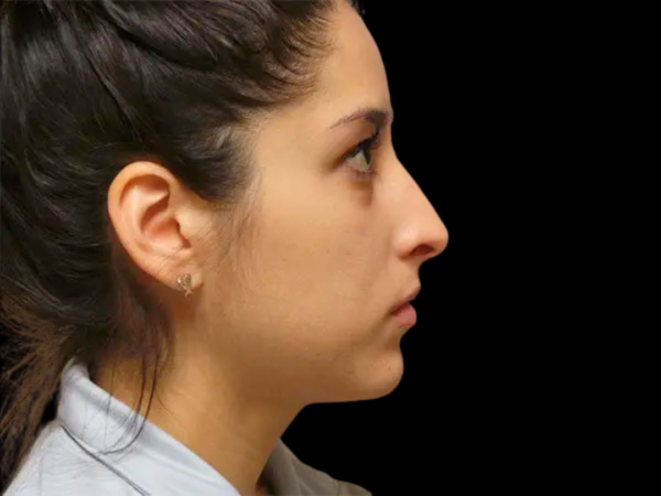 Rhinoplasty Patient 20 Before 1