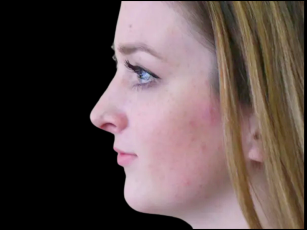 Rhinoplasty Patient 23 After 1