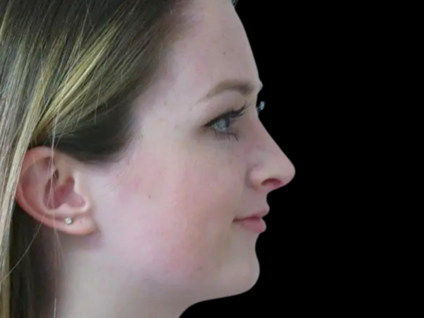 Rhinoplasty Patient 23 After 2