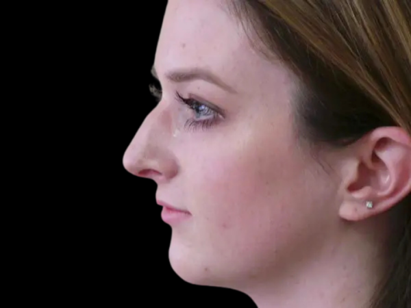 Rhinoplasty Patient 23 Before 1