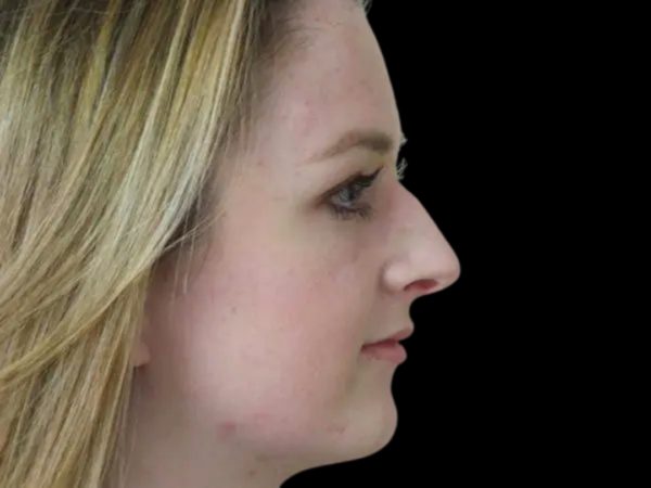 Rhinoplasty Patient 23 Before 2