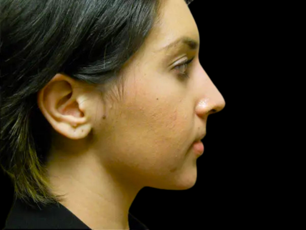 Rhinoplasty Patient 22 After 1