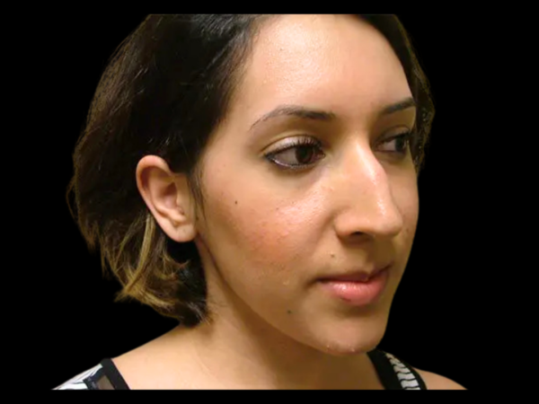 Rhinoplasty Patient 22 Before 2