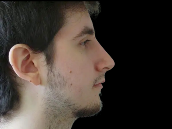 Rhinoplasty Patient 21 After 1