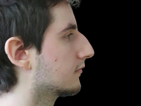 Rhinoplasty Patient 21 Before 1