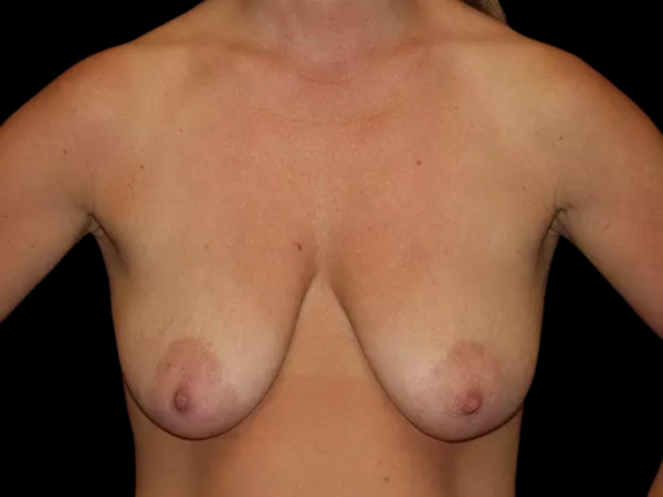 Breast Augmentation With Lift #898 Before 1