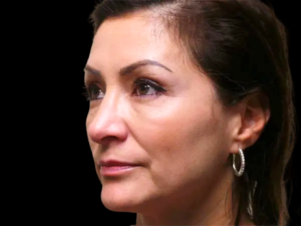 Rhinoplasty Patient 26 After 2