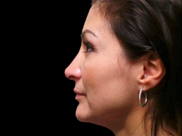 Rhinoplasty Patient 26 After 1