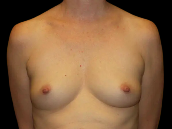 Breast Augmentation Patient 16 Before 1