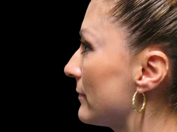 Rhinoplasty Patient 26 Before 1