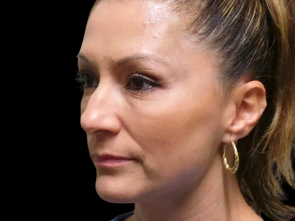 Rhinoplasty Patient 26 Before 2