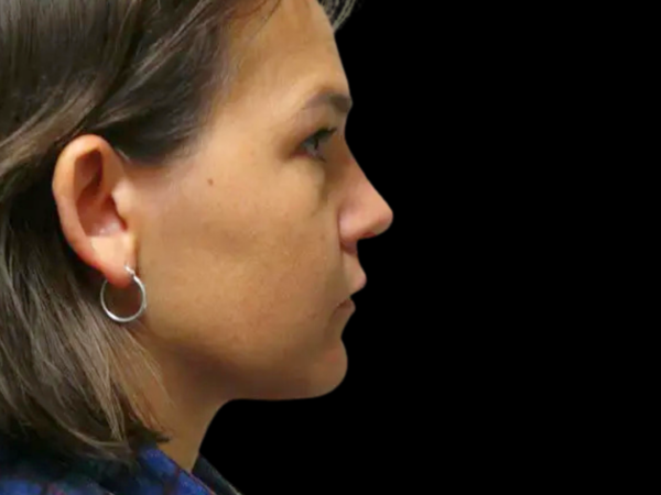 Rhinoplasty Patient 28 After 1