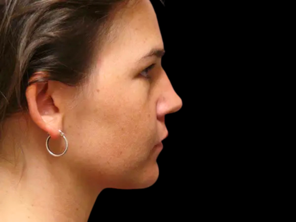 Rhinoplasty Patient 28 Before 1