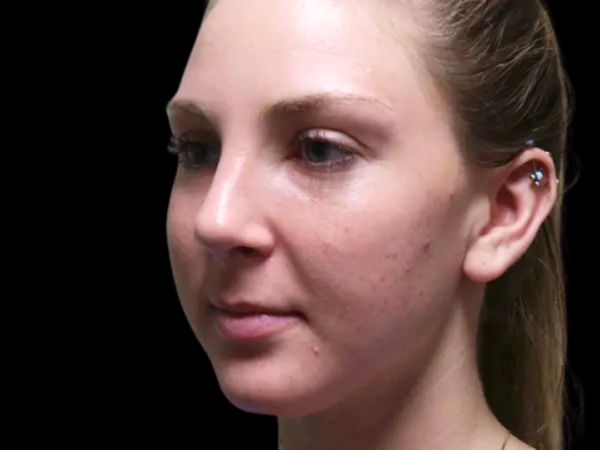 Rhinoplasty Patient 27 After 1