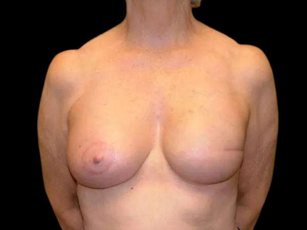 Breast Reconstruction Patient 03 After 1