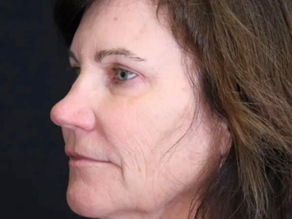 Eyelid Surgery Patient 24 After 1