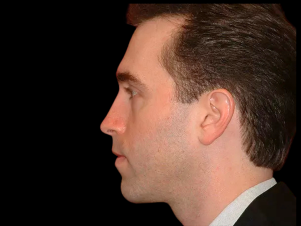 Chin Augmentation Patient 05 After 2