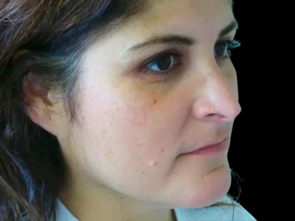 Rhinoplasty Patient 50 After 1