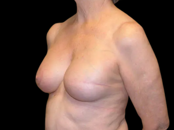Breast Reconstruction Patient 03 After 2