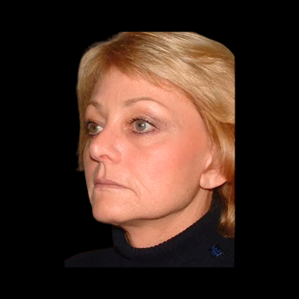 FaceLift Patient 16 After 1