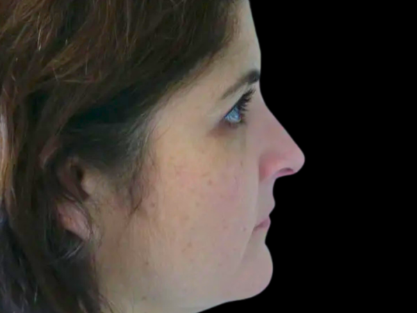 Rhinoplasty Patient 50 After 2